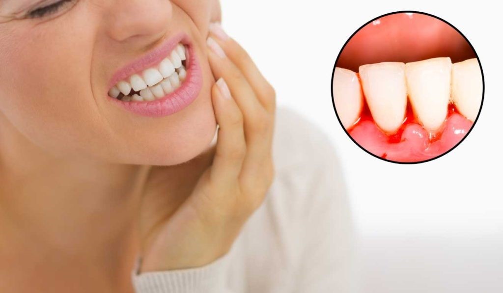 Điều trị viêm lợi chảy máu chân răng như thế nào?
